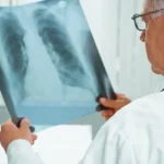 Água no Pulmão - Sintomas, Causas e Tratamento aqui